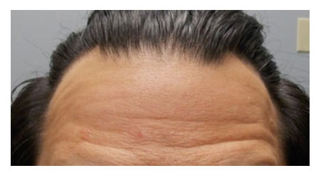 botox-a-1 botox-a-1