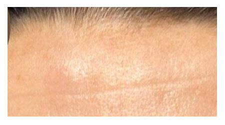 botox-a-2 botox-a-2