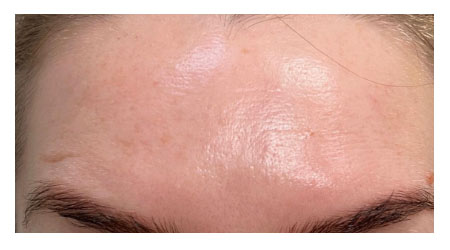 botox-a-3 botox-a-3