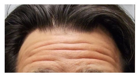 botox-b-1 botox-b-1