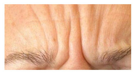 botox-b-2 botox-b-2