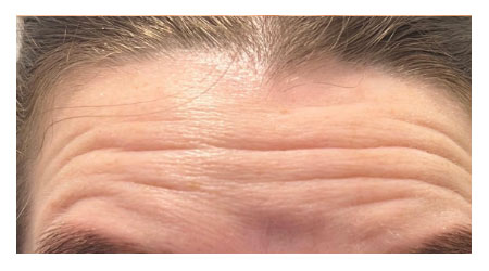 botox-b-3 botox-b-3