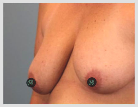 breast-lift-b-2