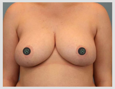 breast-reproduction-a-1