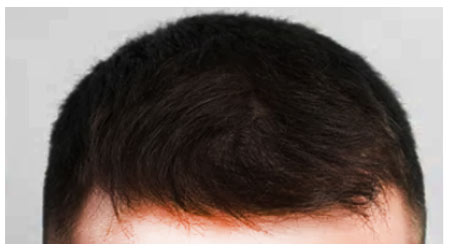 mesotherapy-a-1 mesotherapy-a-1