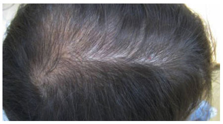 mesotherapy-a-2 mesotherapy-a-2
