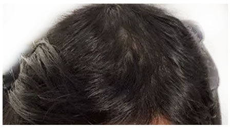 mesotherapy-a-3 mesotherapy-a-3