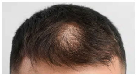 mesotherapy-b-1 mesotherapy-b-1