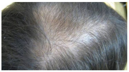 mesotherapy-b-2 mesotherapy-b-2